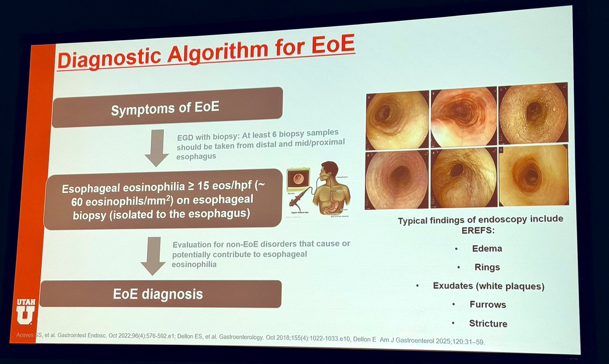 Clinical features #EoE:

🔹IMPACT🔹

I = Imbibe (lots of fluids)
M = Modify (eating habits)
P = Prolonged (eat time)
A = Avoid (certain foods/pills)
C = Chew (repeatedly)
T = Turn away (from food)

🔥 #EosinophilicEsophagitis talk by #DrKathrynPeterson!

#TSGE2025
<a href="/TexasGastros/">Texas Society for Gastroenterology and Endoscopy</a>