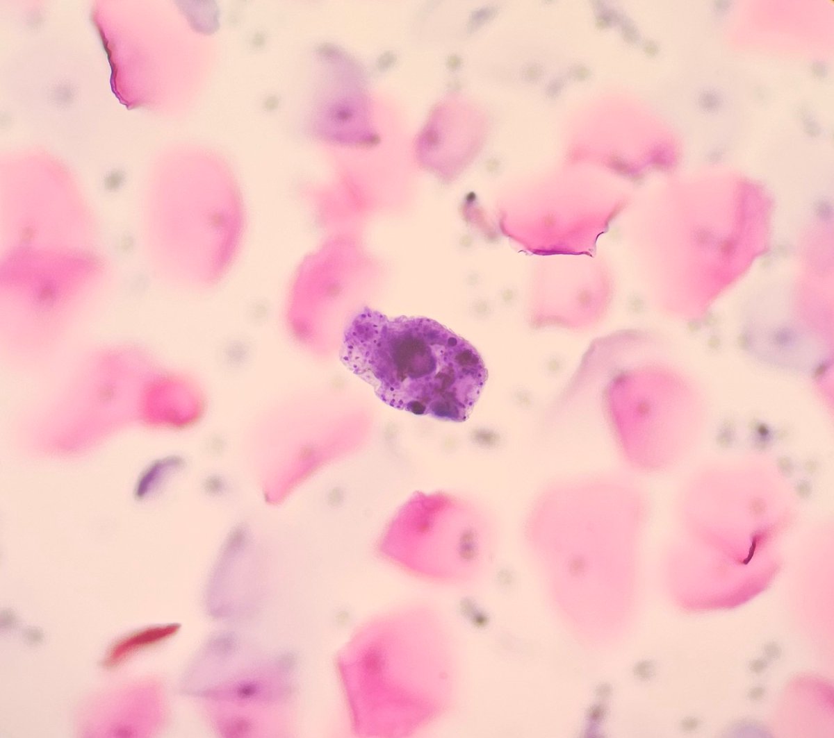 AnupamaArya12's tweet image. 49/F Pap smear.What are these structures? #Pap #cytopath #pathtwitter @pepeheffernan @NayarRitu @vi_monappa @DrGeeONE @kr_abhisek