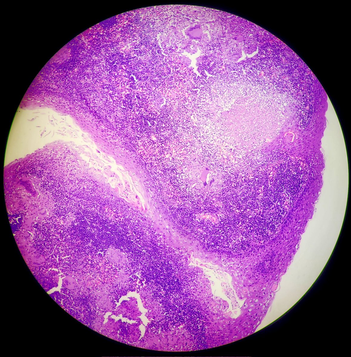 SyedSal55391459's tweet photo. #histopathology
#tonsil
#pathX
#pathTwitter
#photomicrograph
Specimen: Tonsil.
Dx: Tuberculosis. https://t.co/Cj9FxBwI2z