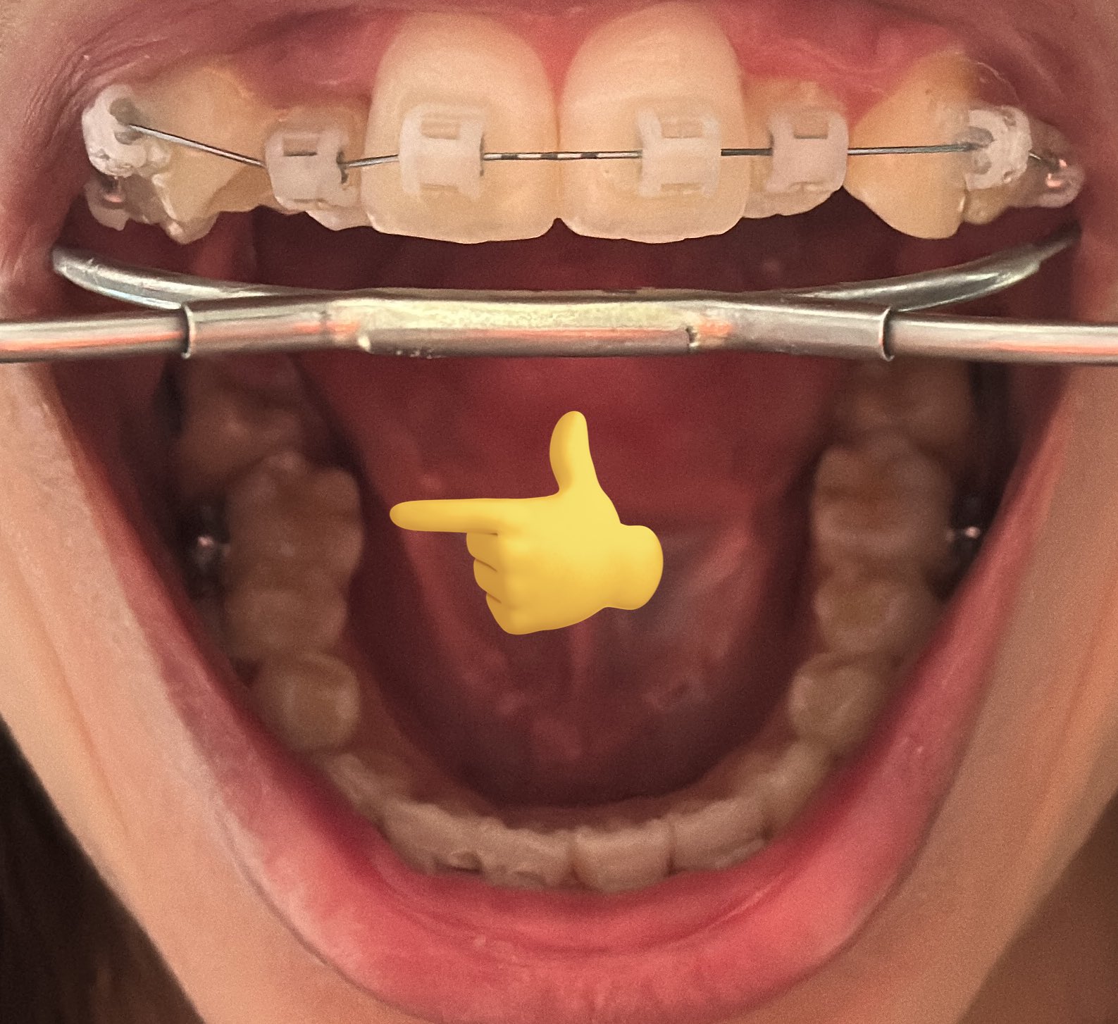 非抜歯矯正 - Search / X