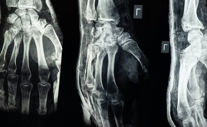 Three X-ray images of a human hand and wrist, showing the bones including fingers, metacarpals, and radius. The images display different angles: one frontal view of the hand, one side view of the wrist, and one elongated view of the forearm and hand.