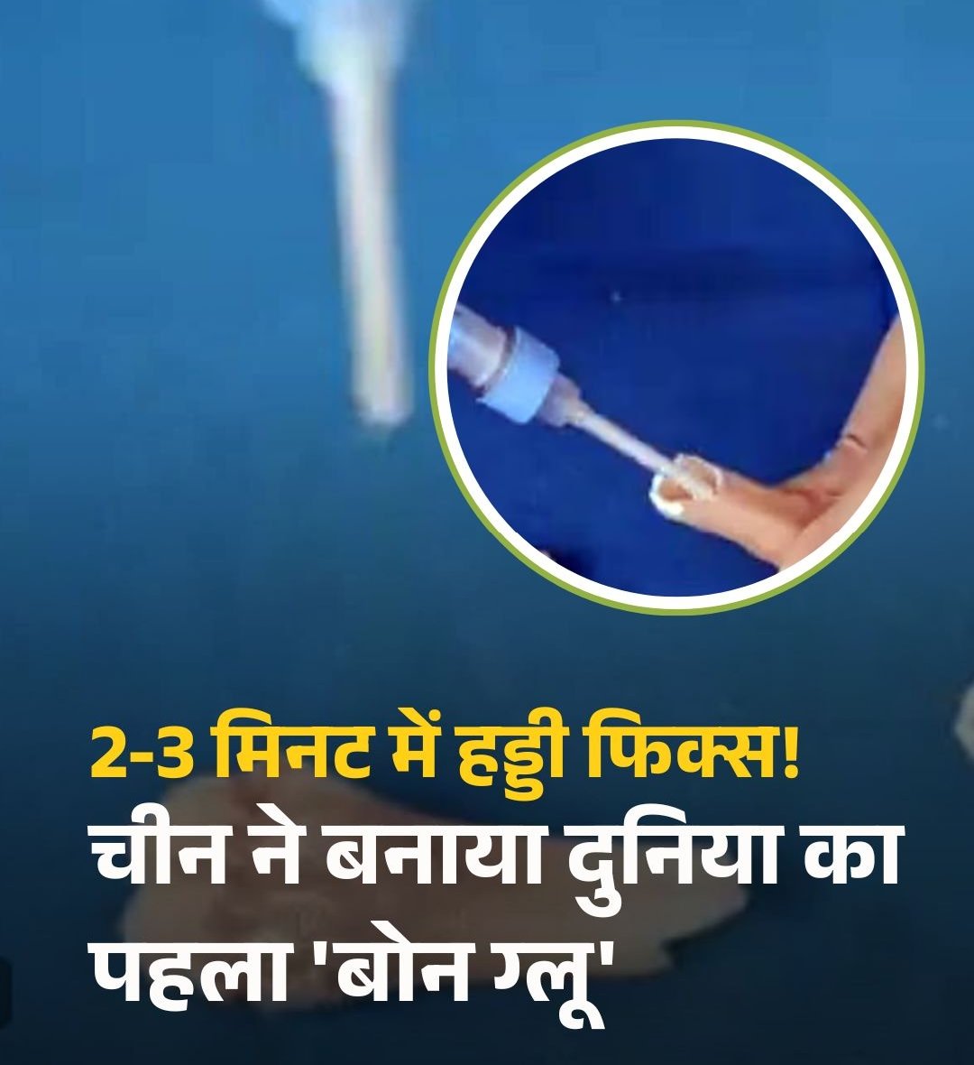 Introvert917's tweet photo. अब टूटी हड्डियों का इलाज होगा और भी आसान! 🩻
चीन के वैज्ञानिकों ने बनाया ‘Bone-02’
ऐसा बोन ग्लू जो फ्रैक्चर को 3 मिनट में जोड़ देता है और धीरे-धीरे शरीर में घुल जाता है।
भविष्य की सर्जरी यहीं से बदल जाएगी!
#Bone02 #BoneGlue https://t.co/AZDCbn1sKl