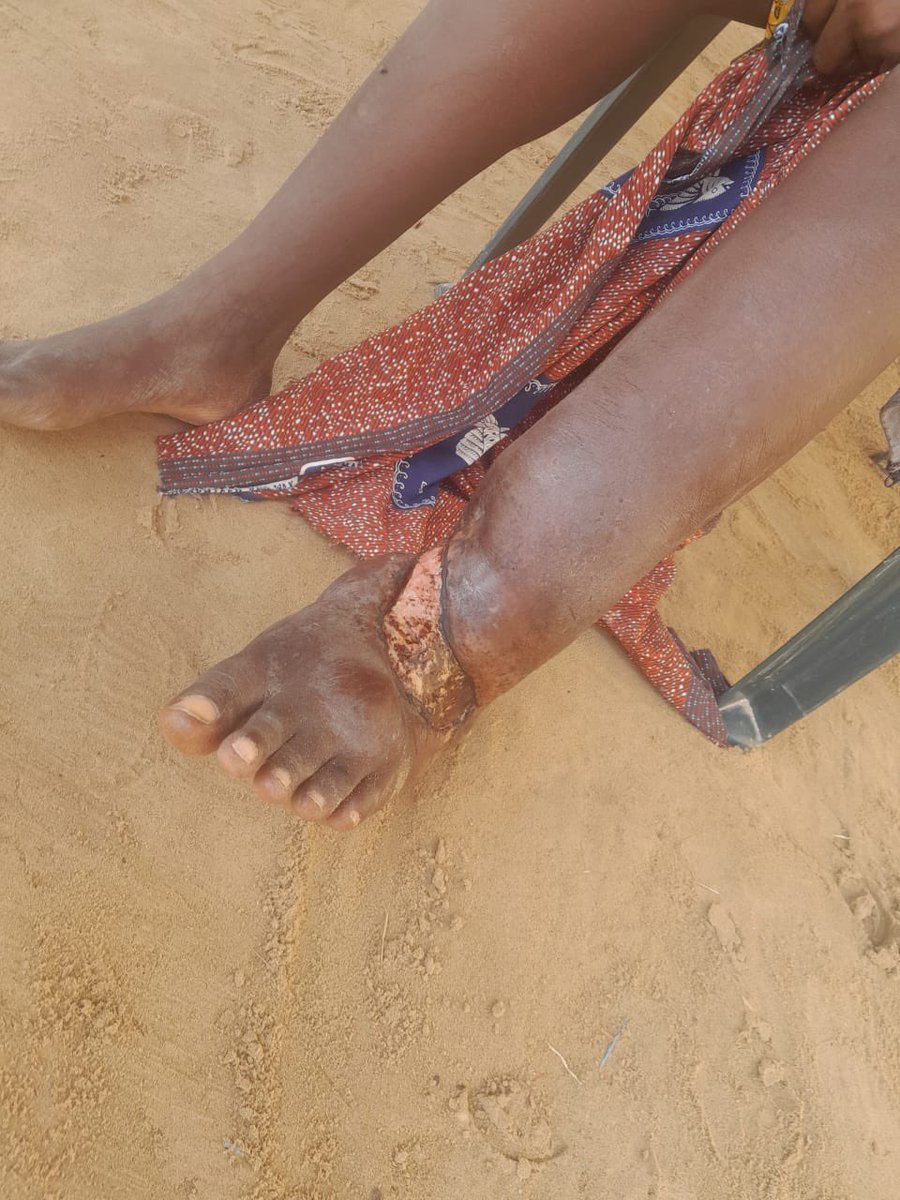 bonesmantv's tweet photo. Abusua this 15years Old Nartey Susanna from Ningo Prampram only needs GHc5,000 to work on her leg or else it will be cut off (Amputated). 
I want anyone touched to help her at least GHc50 or more to raise this money for this young girl before tomorrow. 
We only need 5,000 to save her from being Amputated. 
To send your Token, 𝗗𝗶𝗮𝗹 *𝟳𝟭𝟯*𝟬𝟯𝟰# OR

𝐃𝐨𝐧𝐚𝐭𝐞 𝐯𝐢𝐚 𝐌𝐨𝐛𝐢𝐥𝐞 𝐌𝐨𝐧𝐞𝐲 𝐭𝐨:
𝟬𝟱𝟰 𝟬𝟭𝟲 𝟵𝟳𝟬𝟳
𝟬𝟮𝟬 𝟮𝟬𝟳 𝟮𝟬𝟮𝟰 
(𝗖𝗹𝗶𝗻𝘁𝗼𝗻 𝗬𝗲𝗯𝗼𝗮𝗵)

𝐆𝐨𝐅𝐮𝐧𝐝𝐌𝐞: https://t.co/b39YZhlXnt

https://t.co/haYZRWpUG9
𝗣𝗹𝗲𝗮𝘀𝗲 𝗸𝗶𝗻𝗱𝗹𝘆 𝗦𝗵𝗮𝗿𝗲 𝘁𝗼 𝗦𝗮𝘃𝗲 𝗮 𝗟𝗶𝗳𝗲

@AmeyawDebrah @KobbyKyei_ @SaddickAdams @kwadwosheldon @Hitz1039FM @Angeltv_Gh @Bigg_paradise @georgeoaddo @samgeorgegh @TheGhanaWeb @gyaigyimii
