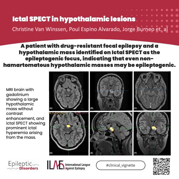A non-hamartomatous hypothalamic mass that was identified as the epileptogenic focus through ictal SPECT imaging. 

🔗doi.org/10.1002/epd2.7…

<a href="/giocastellucci/">Giovanni Castellucci, MD, MS</a> <a href="/joanajribeiro/">Joana Ribeiro</a> <a href="/SheikhISMD/">irfan sheikh 伊凡</a> <a href="/AlinaIvaniuk/">Alina Ivaniuk 🇺🇦</a> <a href="/SBeniczky/">Sandor Beniczky</a> <a href="/AnphyLab/">The AnPhy Lab</a>