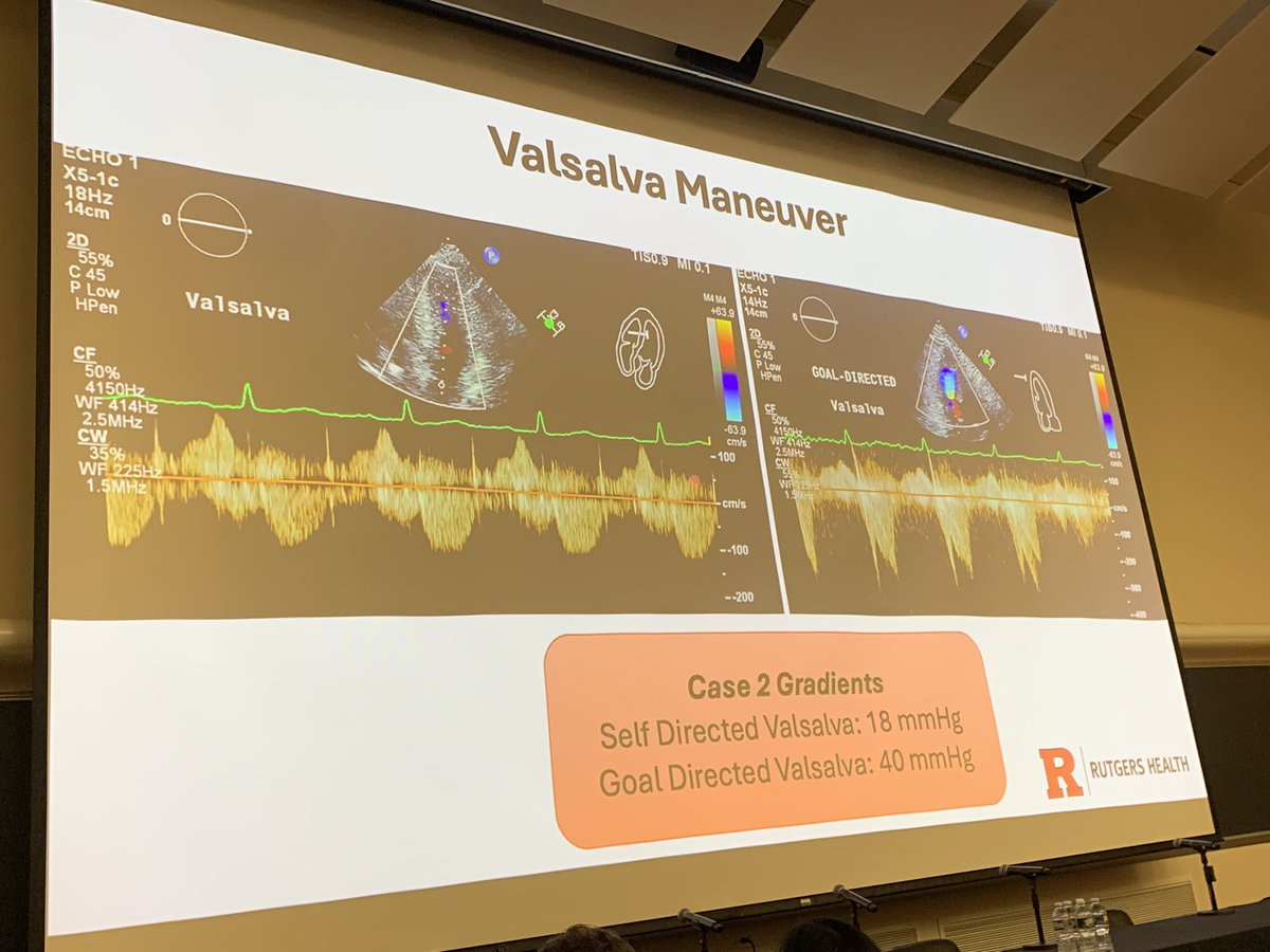 YantingWangMD's tweet image. Happening Now: 2nd Annual Rutgers Echo Symposium  show efficacy of easy and reproducible Goal Directed Valsalva during HCM evaluation in the echo lab. @RWJMS @RWJUH @KamuMaganti @HamiraniYasmin @ppsengupta1 @ChonyAlbertMD #echofirst @ASE360