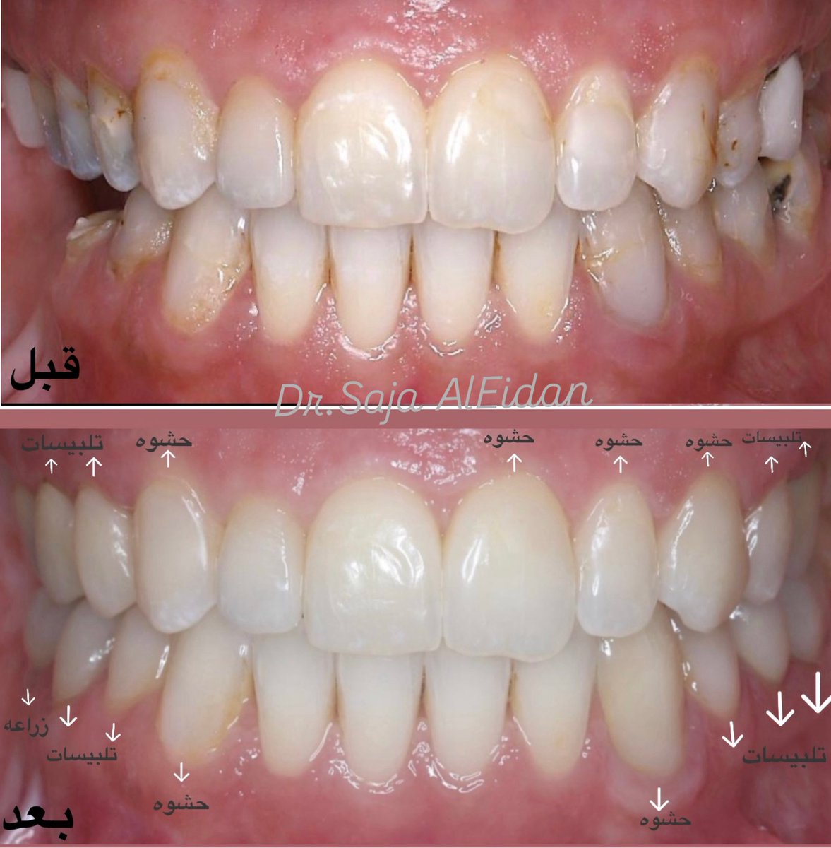 قبل ✨ وبعد ✨
من ابتسامة فيها مشاكل قديمة ⬅️ لابتسامة صحية وجميلة 💎
بعد عمل حشوات تجميلية وتركيبات (تلبيسات) متناسقة ✨

#حشوات_تجميليه #حشوات #حشوات_خلفيه #حشوات_أماميه
#اسنان #smile #composite #dentistry