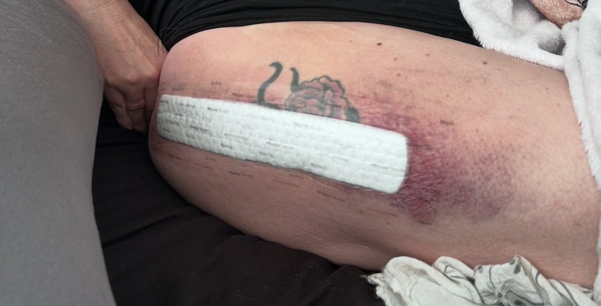 wickedladybiker's tweet image. you know the morphine is wild when you've been chatting in an 🇦🇺 skate shop with Tommy Robinson 😳 whether you should buy the blue roller skates 🤣🤣🤣 #hipreplacement