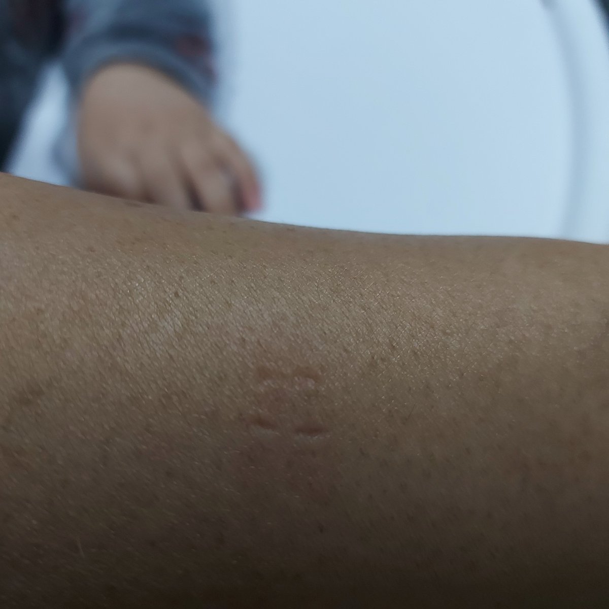 Pensé que me agarraba el brazo para hacerme mimitos y resulta que me dejó de recuerdo sus 4 dientecitos marcados en mi bracito . El mini Suárez es mi hijo Simón de 8 meses y medio
