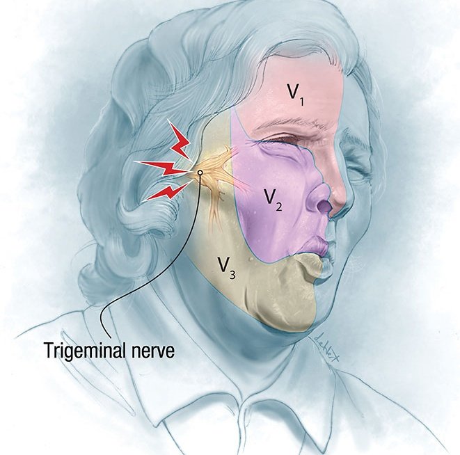 DOC for trigeminal neuralgia:

A) Gabapentin
B) Carbamazepine
C) Phenytoin
D) Valproate