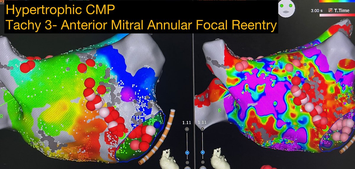 Atypical flutters in Hypertrophic cardiomyopathy #electrophysiology
