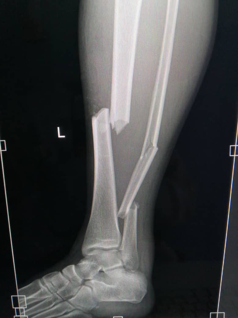 APPEALING FOR HELP FOR TINOTENDA MUNAVA

Tinotenda Munava (22years) had an accident on 14 August 2025 and was taken to Harare Central Hospital. His leg was broken in 3 places. See picture below. 

The doctors now recommend a surgical procedure to hold the broken bones together