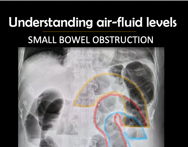 simply_rad11's tweet photo. Understanding air-fluid levels in obstruction
https://t.co/jfCrhuKANe https://t.co/0EicetW1m0