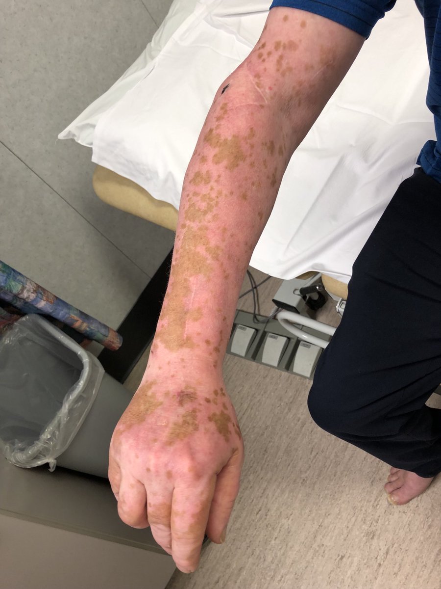 Janetbirdope's tweet image. #Diagnosis in 1 #picture

#Photosensitivity worsened by #depigmentation 

Negative #ANA   
Positive #Ro / SSA

#ClinicalPearl