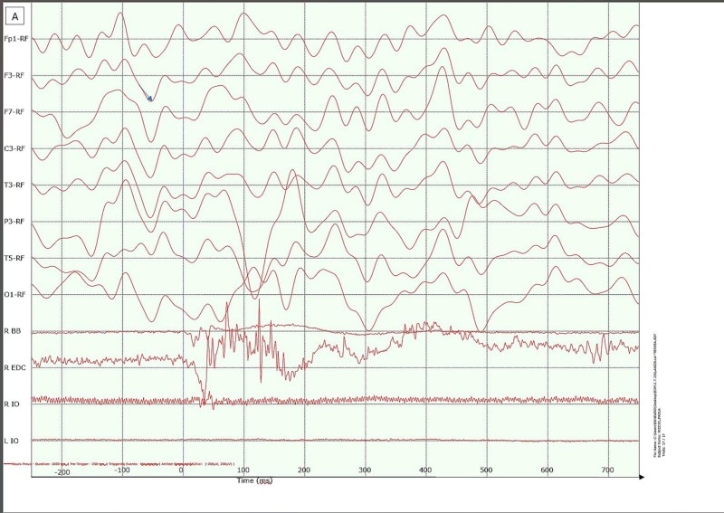 [Myoclonus in multiple sclerosis] Trinchillo et al.: "Here, we present the first documented case of cortical myoclonus in a patient, occurring two years after she was diagnosed with multiple sclerosis." doi.org/10.1016/j.clin…