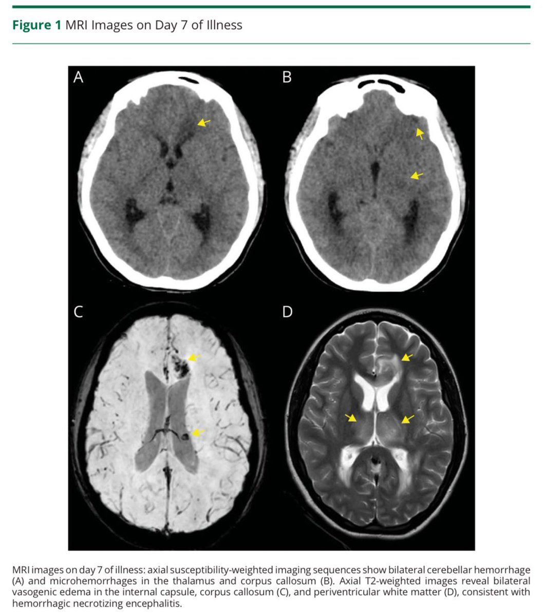 r_gruezo's tweet photo. 🚨 ¡New paper! 
Los primeros ecuatorianos en publicar en esta sección. 
🧠 Hemorrhagic necrotizing encephalitis as the 1st sign of CNS #TB.
📈 Rapid course in 48h: severe neurological decline.
💊 Early clinical suspicion + prompt anti-TB therapy &amp; steroids = survival key. https://t.co/78LnqZVgJ4