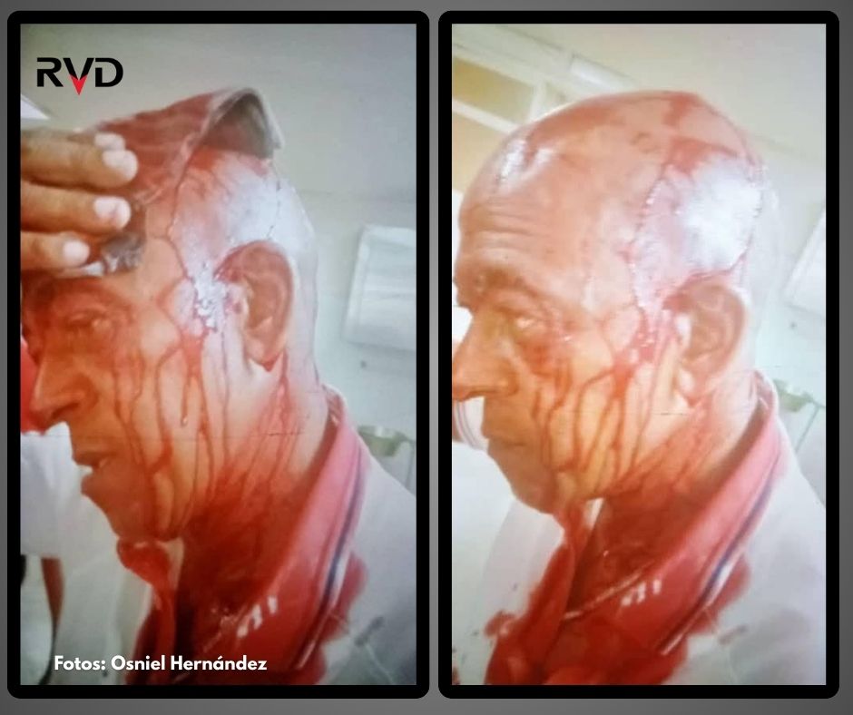 ⚠️ Escándalo en la 64 SNB:  
El director de Sancti Spíritus, Eriel Sánchez, agredió con un bate al comisario técnico Miguel Rojas en su oficina tras el juego vs. Isla.  
Rojas sufrió una herida en la cabeza que requirió sutura.  

✍️ Osniel Hernández