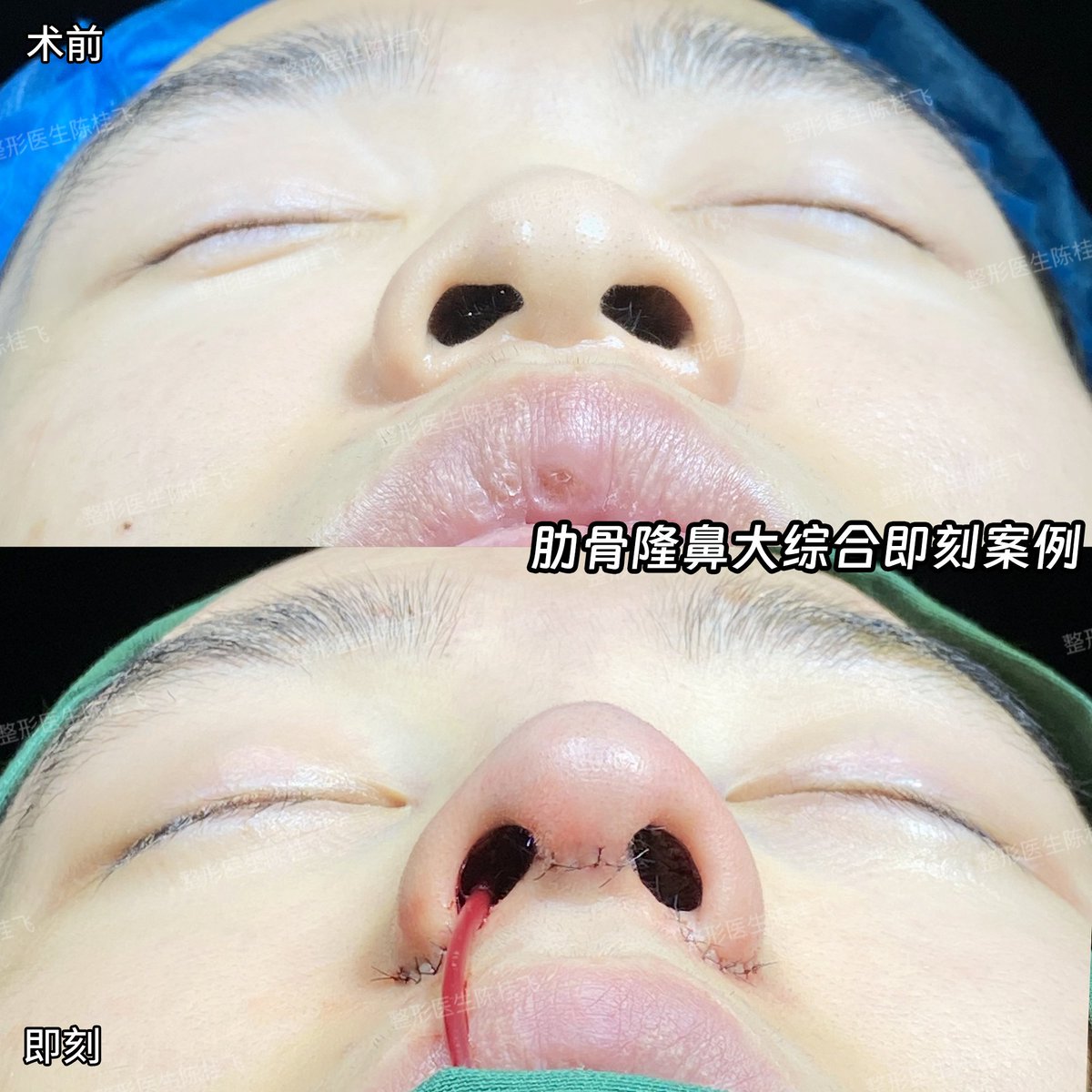 yeoncich's tweet photo. 男性の鼻整形症例：顔が比較的平坦で、男性らしい立体感とシャープさが欠けています。  

施術：ポリテトラフルオロエチレン（PTFE）とリブ増強を組み合わせ、まっすぐな鼻とやや隆起した鼻背を実現しました。 

#鼻 #深圳鼻整形 #陥没鼻 #陳桂菲 #陳桂菲整形 #ストレートノーズ

💕Line: himttu https://t.co/pNSuCPrp6n