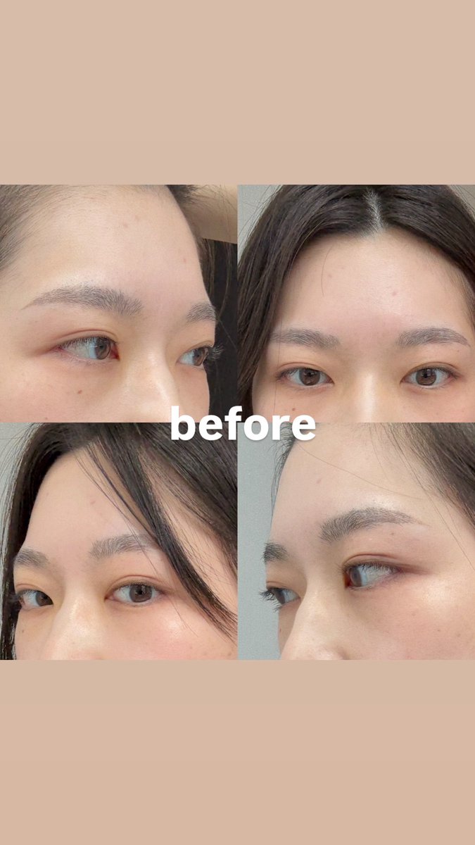 ﾂﾅ🐟内視鏡額リフトDT tweet media