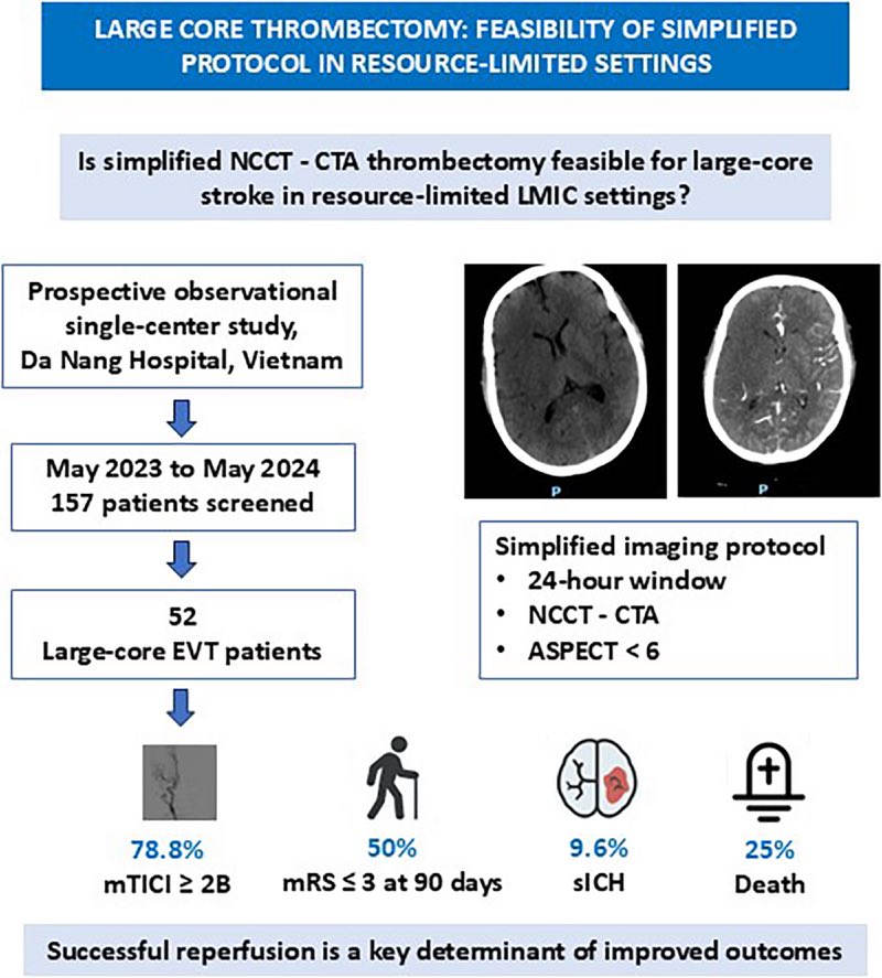 Large Core Thrombectomy: Feasibility of Simplified Protocol in Resource‐Limited Settings | Stroke: Vascular and Interventional Neurology ahajournals.org/doi/full/10.11… <a href="/StrokeAHA_ASA/">Stroke AHA/ASA</a> <a href="/SVINJournal/">Stroke: Vascular and Interventional Neurology</a> <a href="/svinsociety/">SVIN</a>