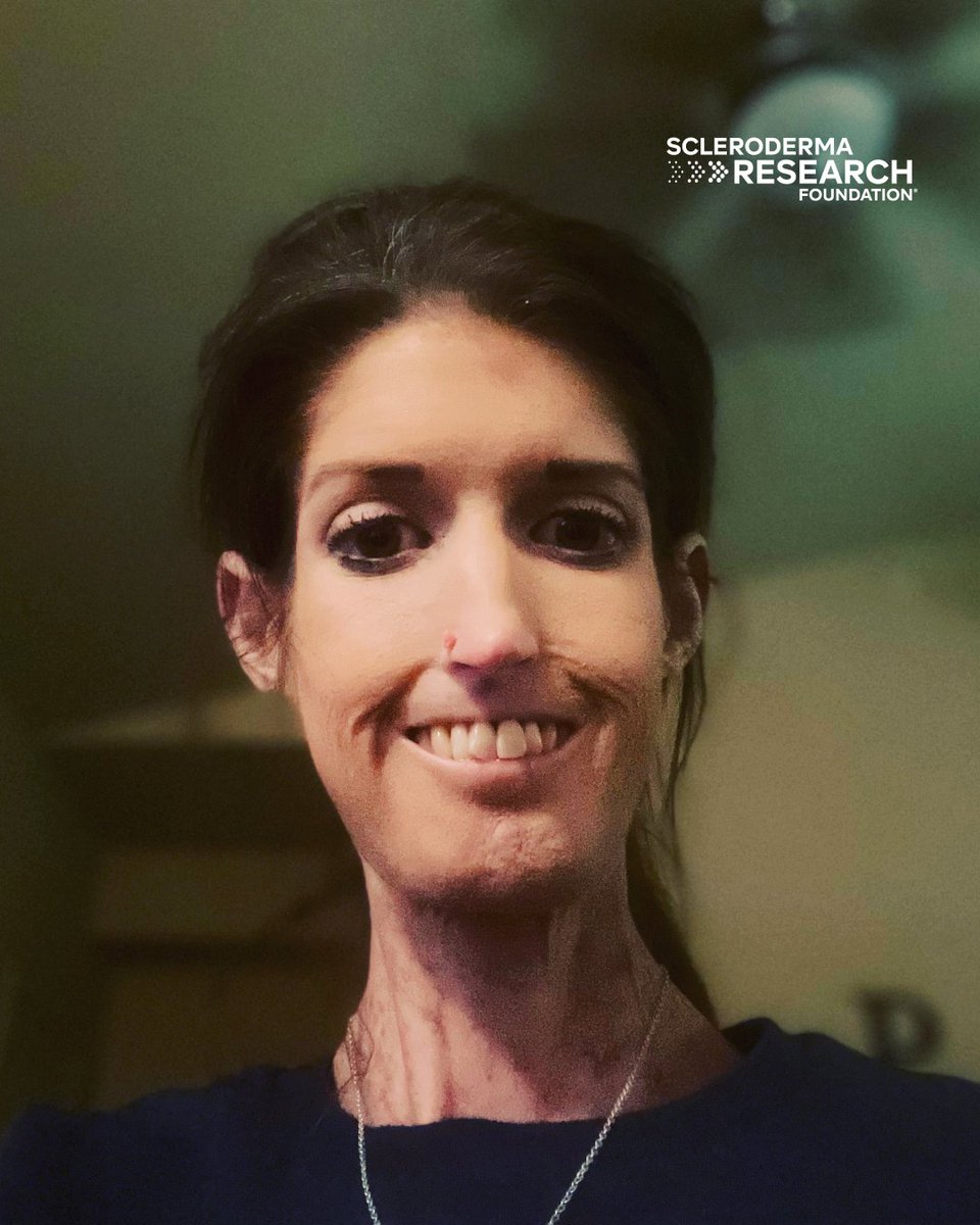 srfcure's tweet image. “Scleroderma research is important to me because our lives would be drastically different without the progress made so far," says Tiffani P. (dx at age 18.)
Read her full story: bit.ly/46Gn0v8
#sclerodermaresearch #scleroderma #SRFcure