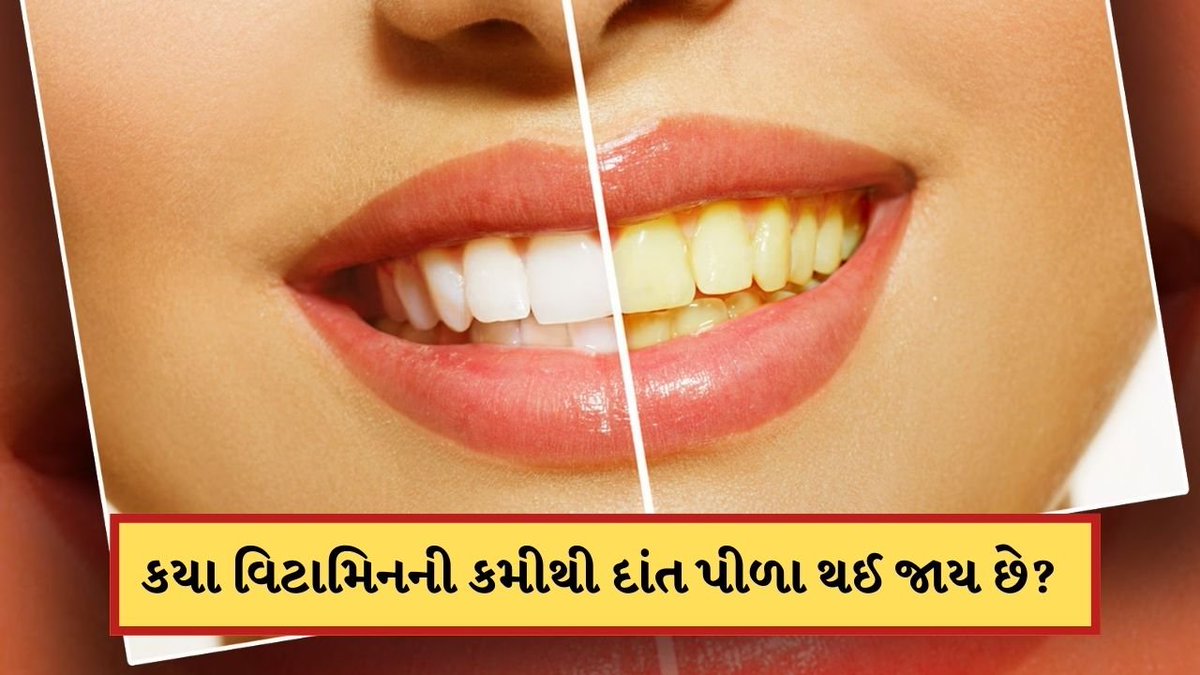 tv9gujarati's tweet photo. કયા વિટામિનની ઉણપથી તમારા દાંત પીળા થઈ જાય છે? જાણો અહીં
#Vitaminc #yellowteeth #vitamic #health #healthtips #lifestyle
https://t.co/v05OOWu3zX https://t.co/kF68tZGAPm