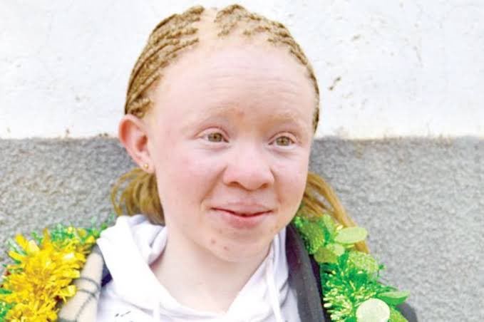 Did you know that under the new Persons with Disabilities Act, persons with albinism are entitled to Free sun screen lotion and lip balms to be provided by GoK. 

Rt to create awareness ✅