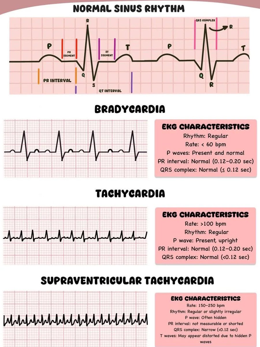 Normal Sinus Rhythm With Tachycardia