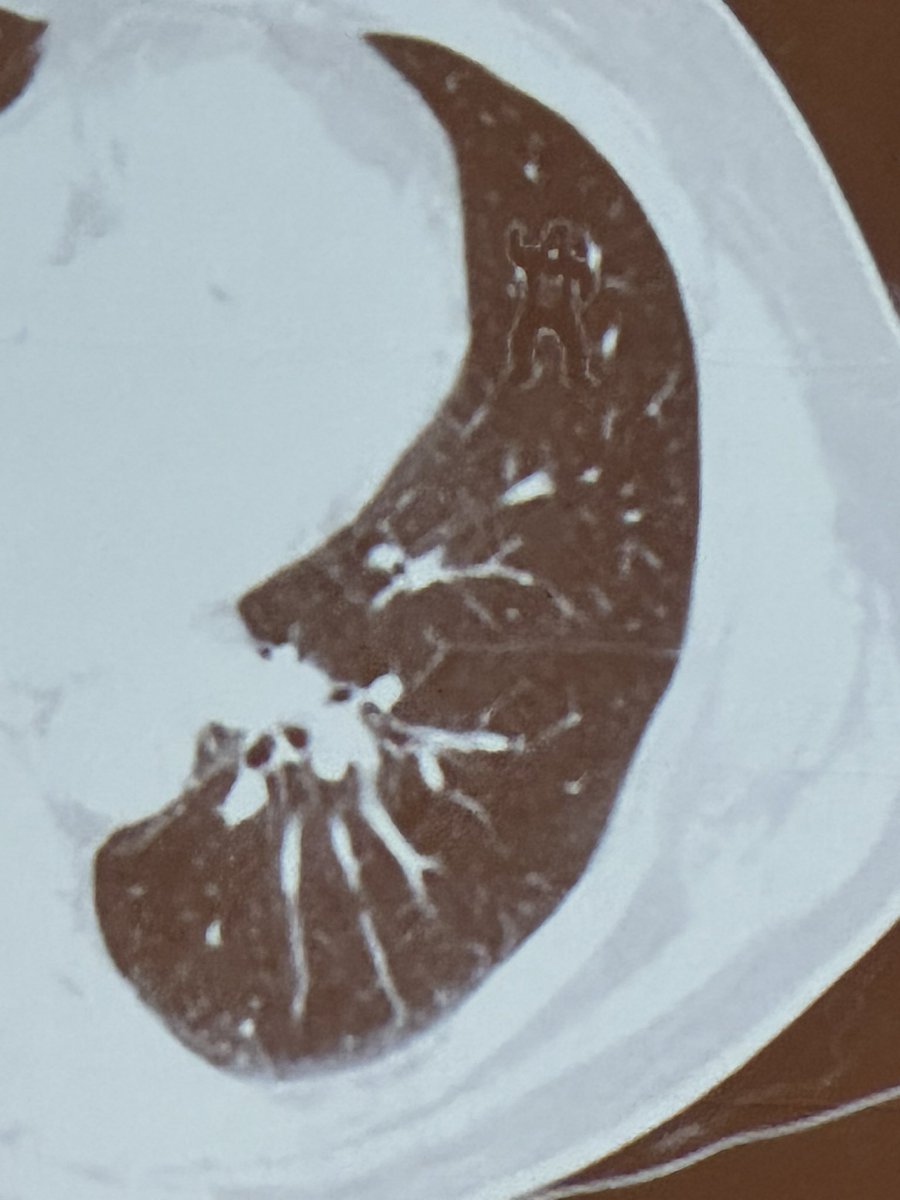 Latinamd's tweet photo. #MLS_DC25 @DrBonillaOnc gives an excellent overview of Artificial Intelligence solutions for lung cancer care, imaging, drug devt. And how big data will drive new discoveries #lcsm https://t.co/v0WTjR7VrV