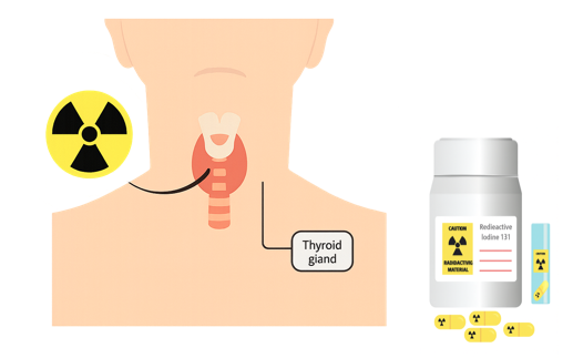SamiiHamad's tweet image. #قصة_إشعاعية

المكان: كوريا الجنوبية🇰🇷

من الأخطاء التي قد تتكرر في المنشآت الطبية عدم الالتزام الصارم بإجراءات التحقق من هوية المريض قبل إعطاءه العلاج، وتتضاعف خطورة العواقب المترتبة على هذه الأخطاء إذا كان الإجراء مرتبط بمواد مشعة☢️.
- ففي إحدى الحالات المسجلة في مستشفى في…