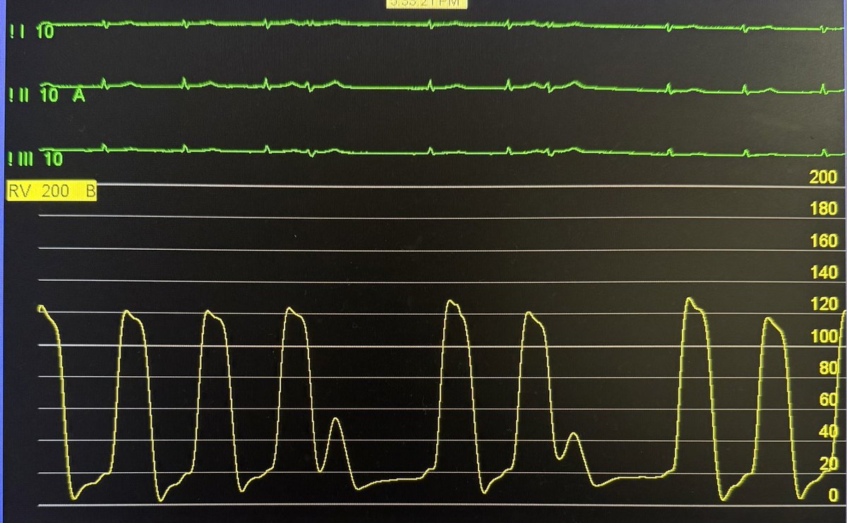DrRajeshG1's tweet image. For fellows, what are the findings from this RV pressure tracing?