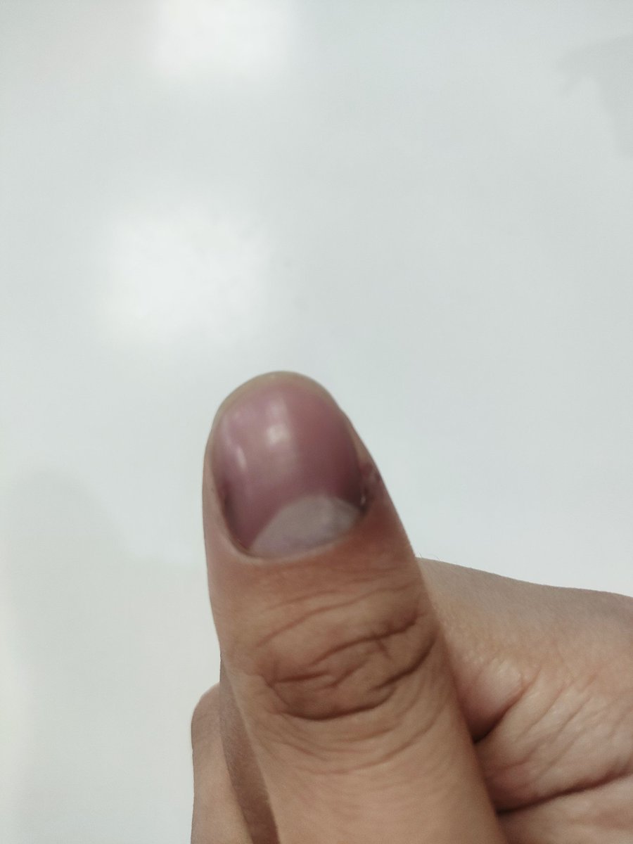 昨天右手大拇指夾傷，左右兩側指甲裂開流血，現在稍微一用力傷口就會流血，感覺就像被針刺到一樣，可能要2個星期才會好......