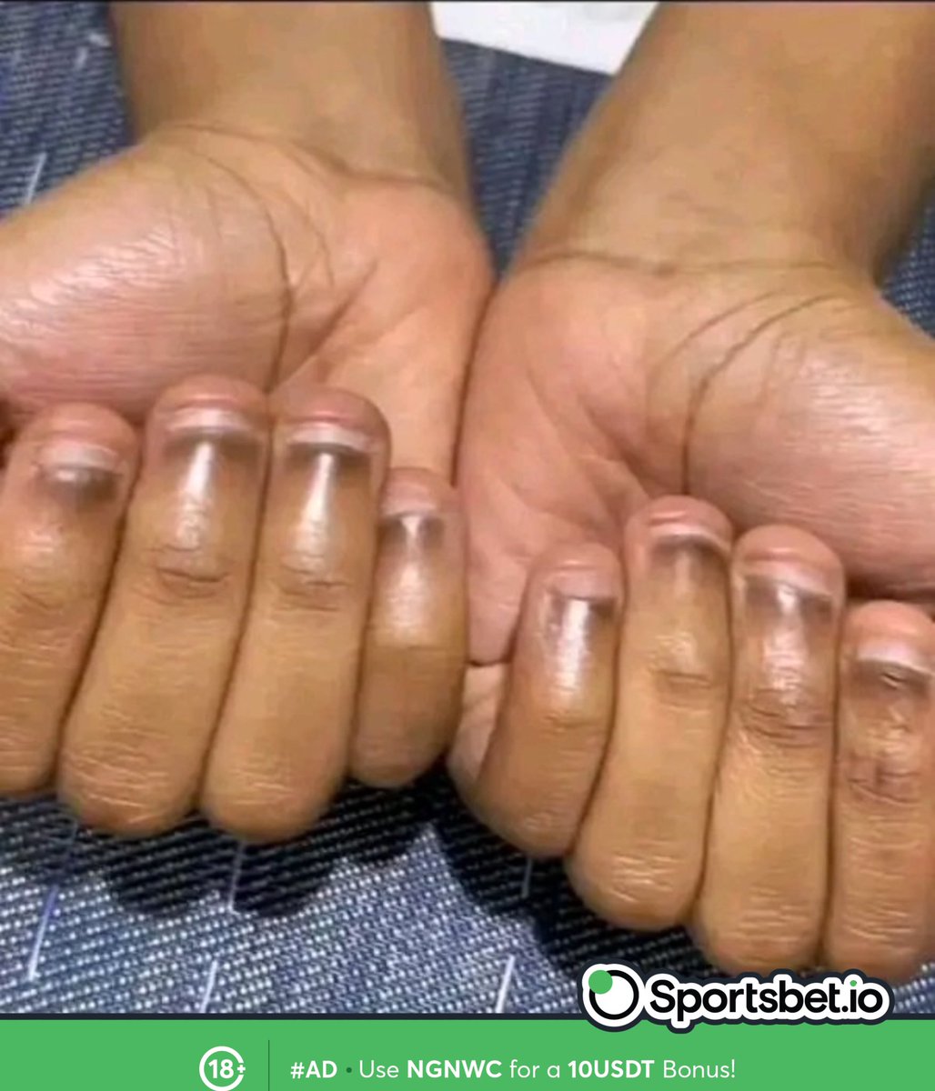 thebigdammy's tweet photo. Facts about people with this kind of fingernails? https://t.co/gfjttB53SJ