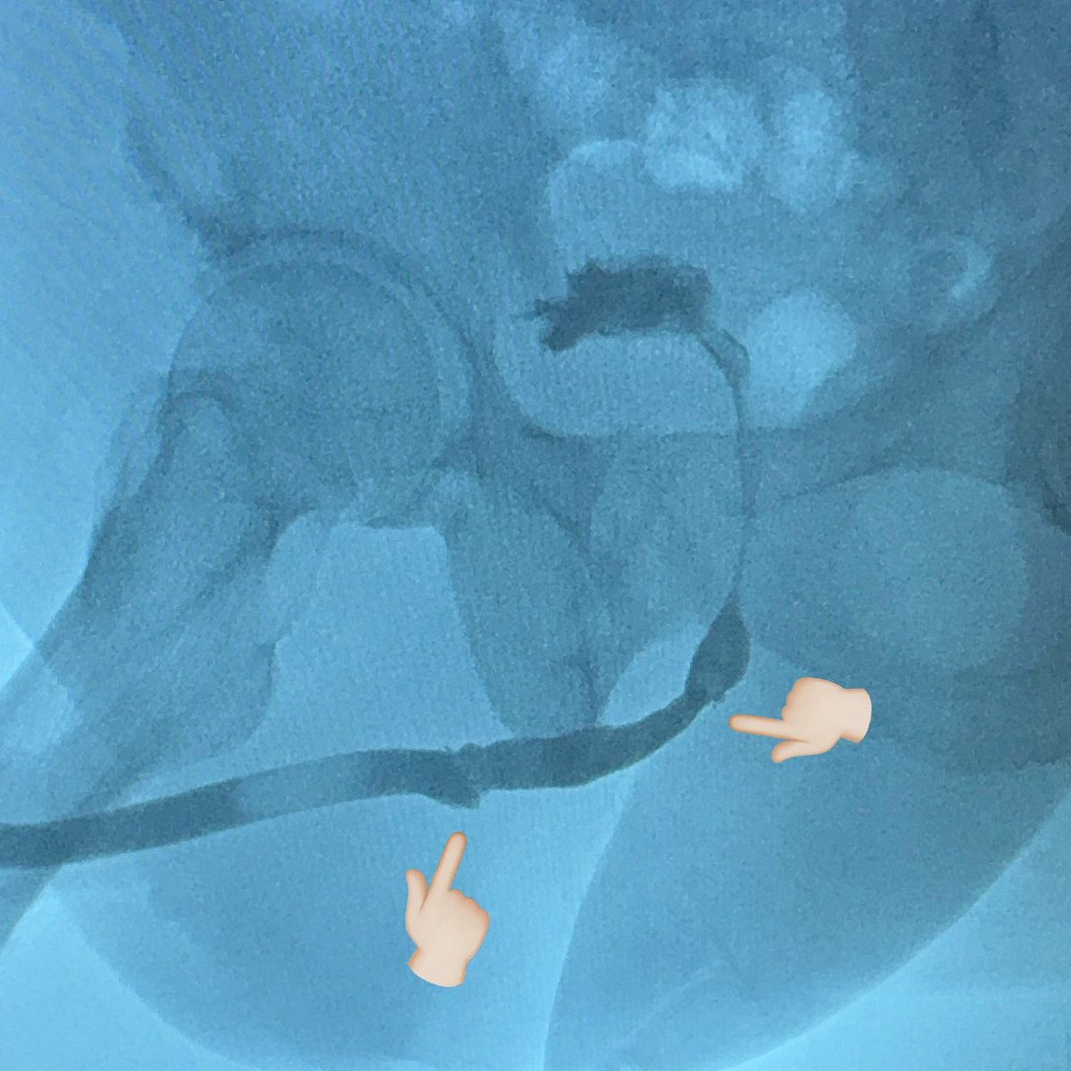 It's an old technique but once you don't have enough urethra to anastomose or augment, pedicled penile skin flap-tube might be the best option left. We also did hyperbaric oxygen therapy (HBOT), which probably helped a-lot. <a href="/abalajontoto/">Mark (Toto) Abalajon MD</a> #redourethroplasty #Pedicledskinflap