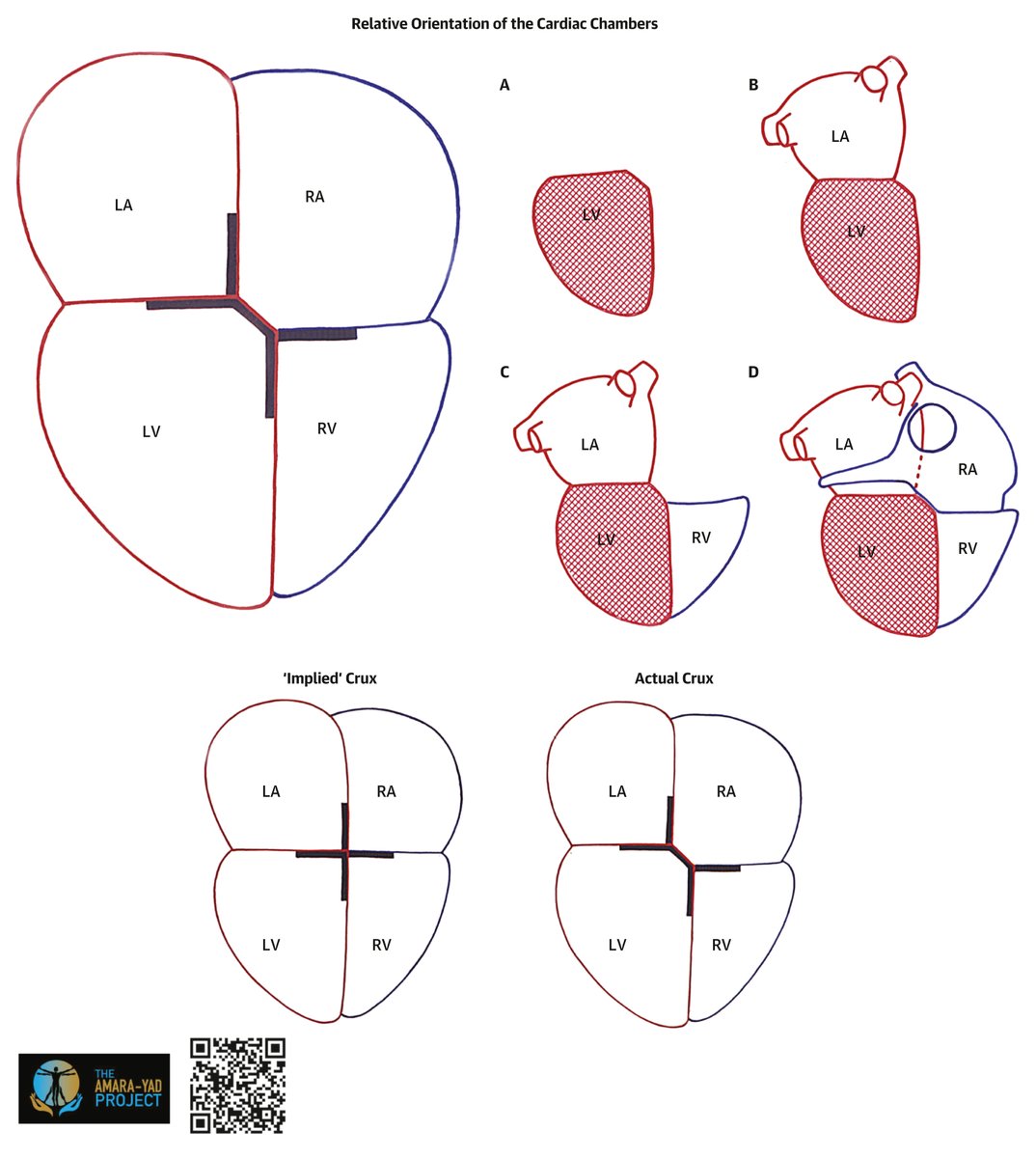 JACCJournals's tweet image. Beyond words: the Amara Yad Image captures the intricate “crux” of the heart, where form meets function. jacc.org/doi/10.1016/j.… #JACC @shivkumarmd