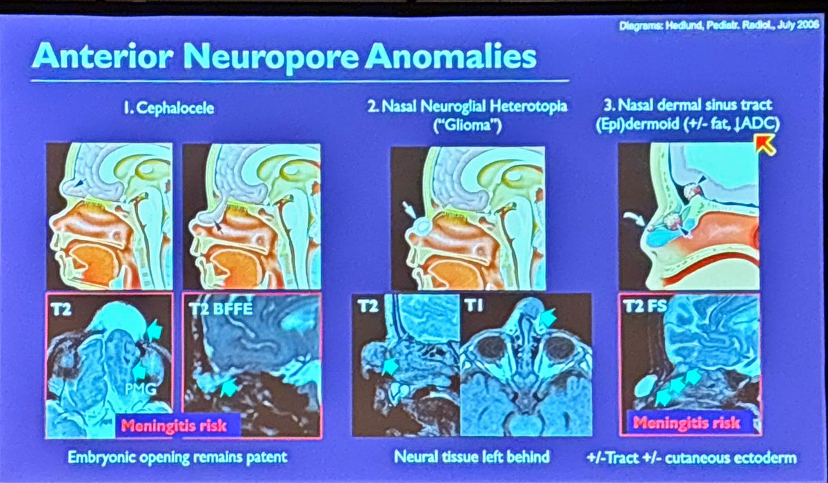 HeadNeckRads's tweet photo. For pediatric nasal lesions, our #1 job is to identify if there is persistent communication with the intracranial compartment.

Asha Sarma at #ASHNR25 https://t.co/Syz8iIYpcE