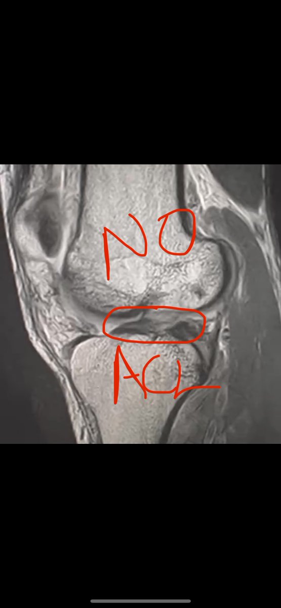 KneeScience's tweet image. ACL Tears Can Heal WITHOUT SURGERY?! 🤯😱

In ~6 months time my client Michael achieved MRI verified ligament re-attachment as shown below 🧵