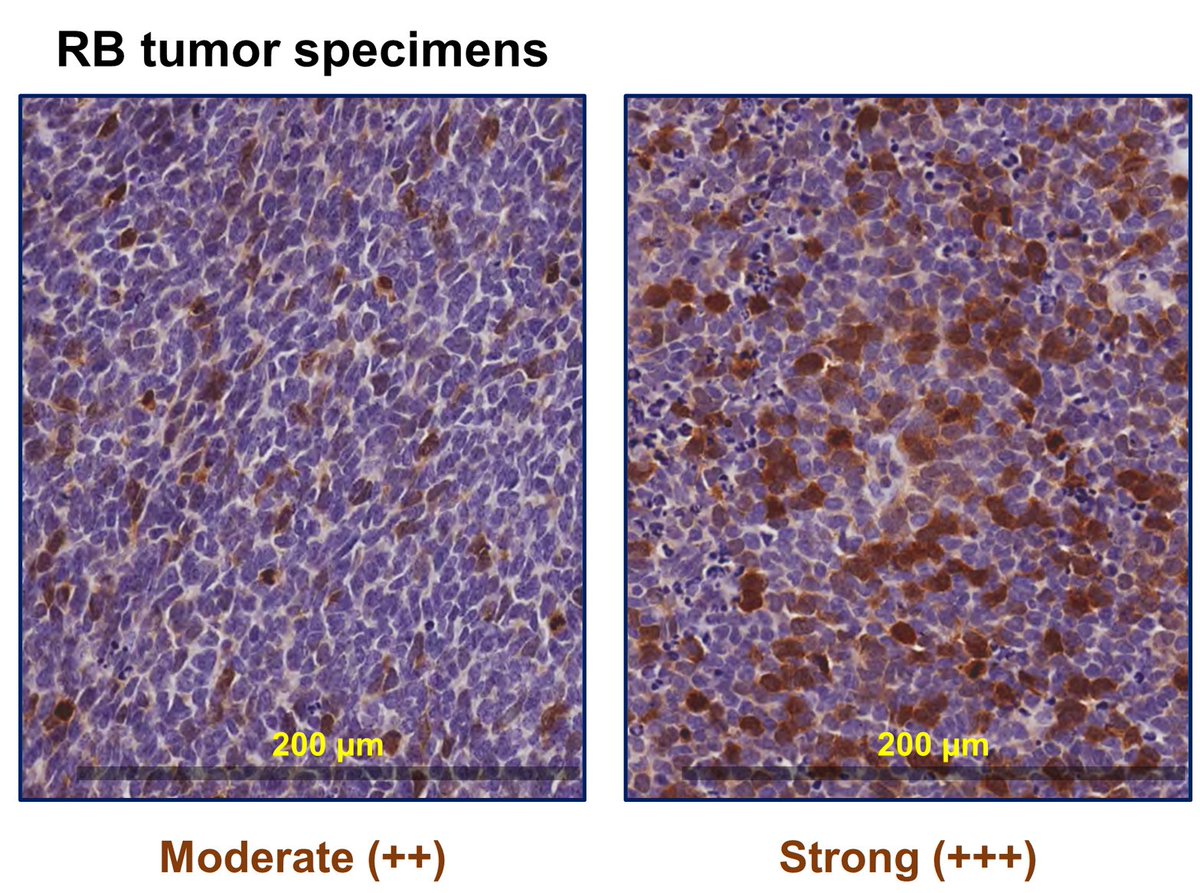 AJPathology's tweet image. #LegacyContent: Aurora Kinase A Is Overexpressed in Human Retinoblastoma and Correlates with Histopathologic High-Risk Factors.  Authors from @lvprasadeye
Free in the #OpenArchive: ajp.amjpathol.org/article/S0002-…