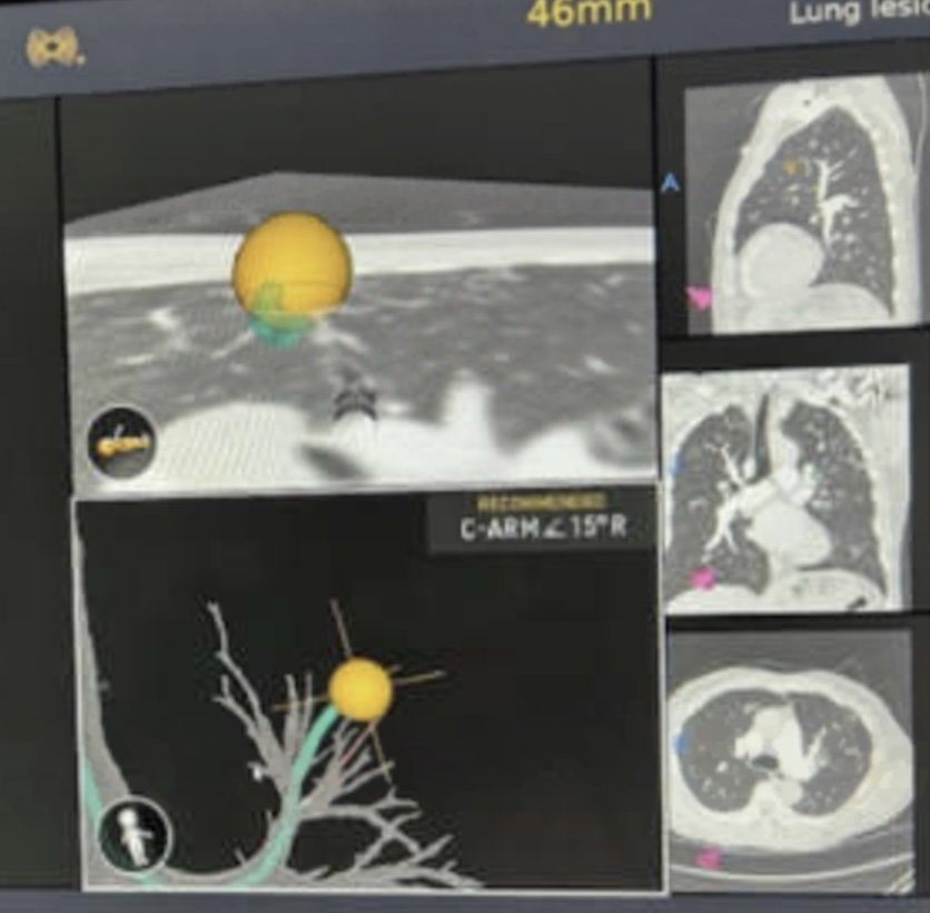 GS_Bronch tweet media