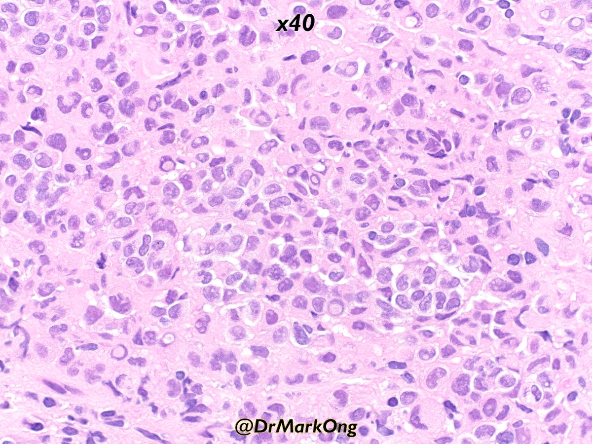 Elderly female with enlarged inguinal lymph node.

Known history of _____?

#PathTwitter #PathX #pathology