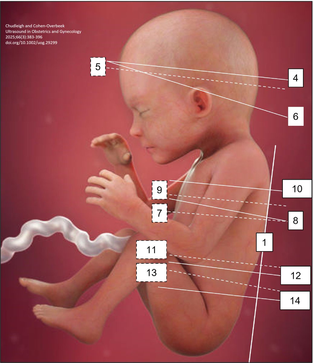 ISUOG's tweet image. If you haven’t already, make sure you check out the new #openaccess &apos;how to&apos; article by Chudleigh and Cohen-Overbeek offering practical guidance on how to apply the 20 + 2-planes method for identification of 65 fetal abnormalities during routine second-trimester ultrasound, as…