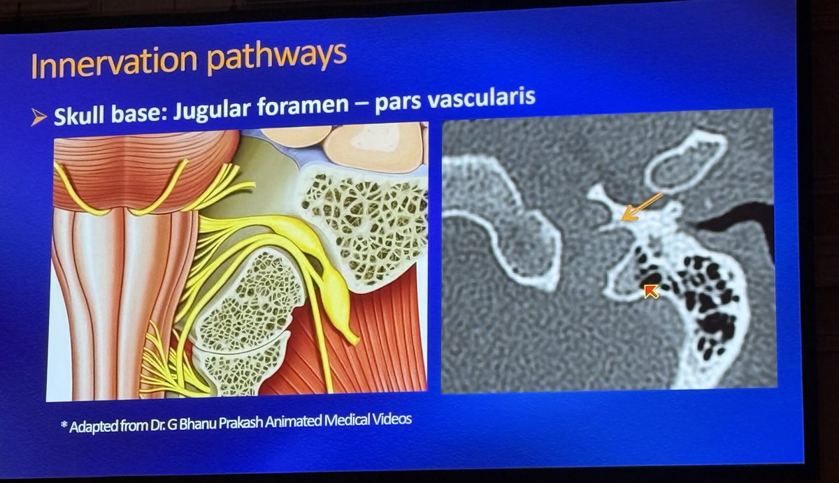 GelbmanM's tweet photo. Interesting pearl from @IlonaSchmalfuss excellent lecture on vocal paralysis at #ASHNR25 :

Preservation of the jugular spine (arrow) helps distinguish a normal asymmetric enlarged jugular foramen from jugular foramen lesions that cause remodeling or destruction. 

@ASHNRSociety https://t.co/WyXkpRuz3l