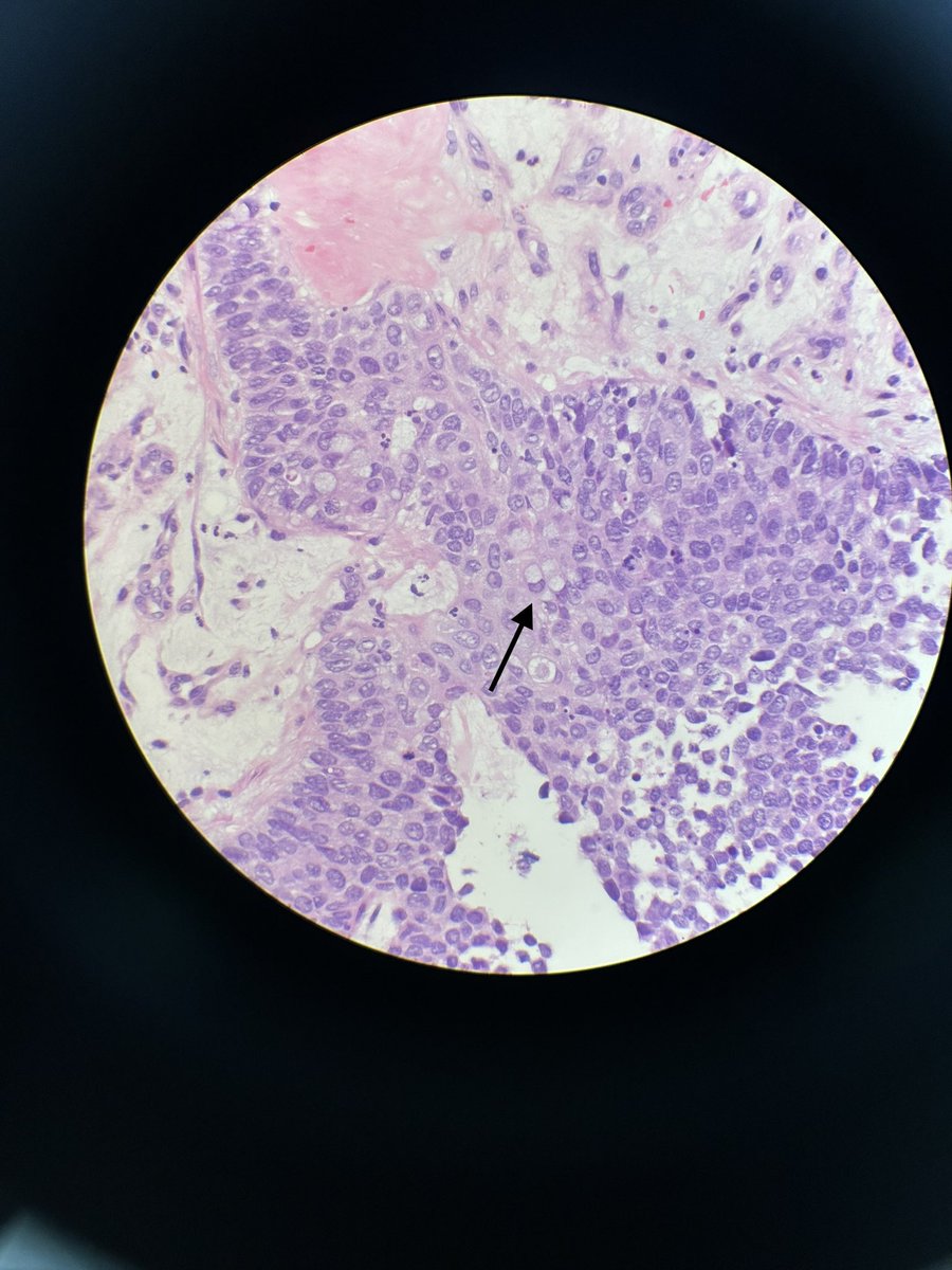 drAfaf_official's tweet photo. HPV associated endocervical adenocarcinoma, invasive stratified mucin producing type. Notice the intracytoplasmic mucin pushing on the nucleus ..  #gynaepath #PathTwitter https://t.co/uZKHNlkhNZ