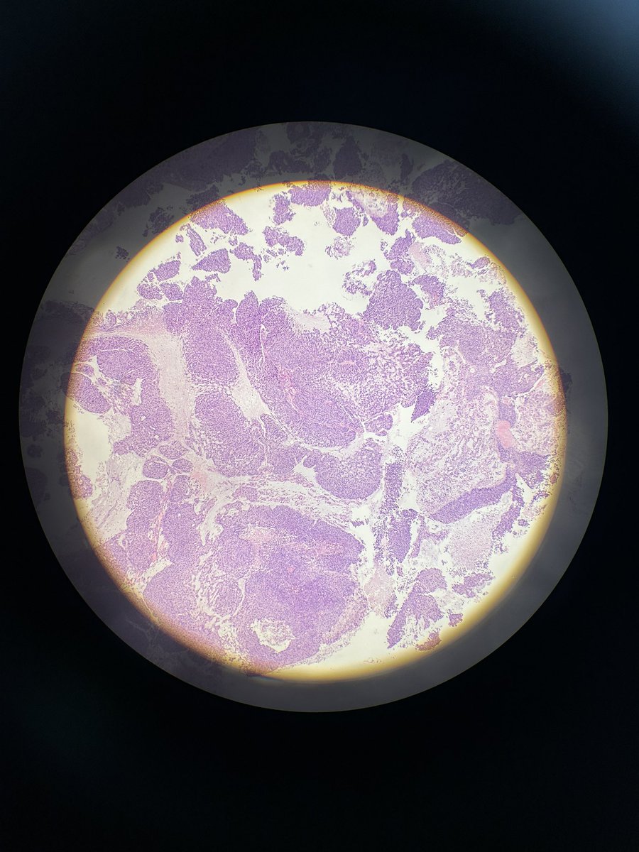 drAfaf_official's tweet photo. HPV associated endocervical adenocarcinoma, invasive stratified mucin producing type. Notice the intracytoplasmic mucin pushing on the nucleus ..  #gynaepath #PathTwitter https://t.co/uZKHNlkhNZ