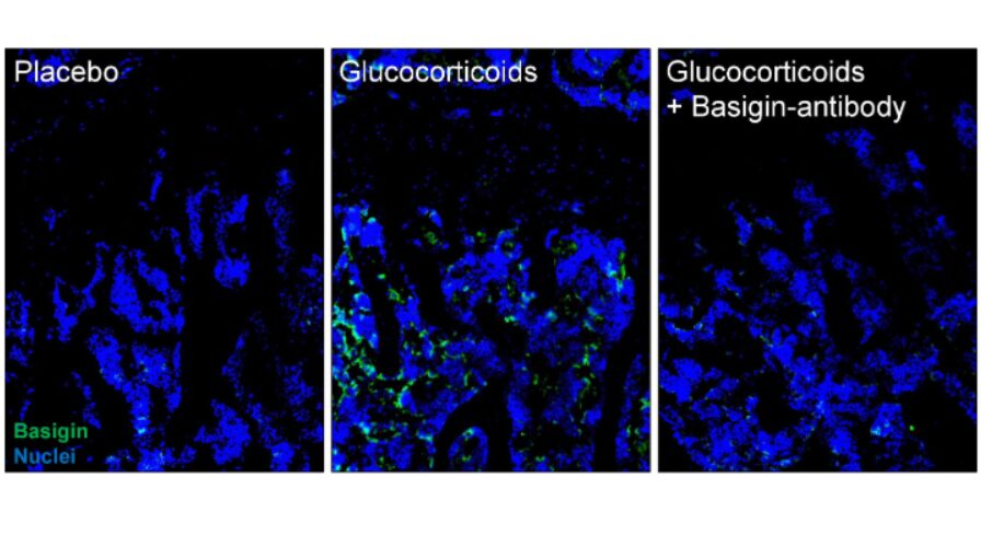 talius's tweet image. UC Davis Health study finds potential #keys to #reversing #bone #loss

Researchers uncover a key protein, Basigin, and a promising strategy to prevent bone damage from steroids... scitechupdates.com/uc-davis-healt…