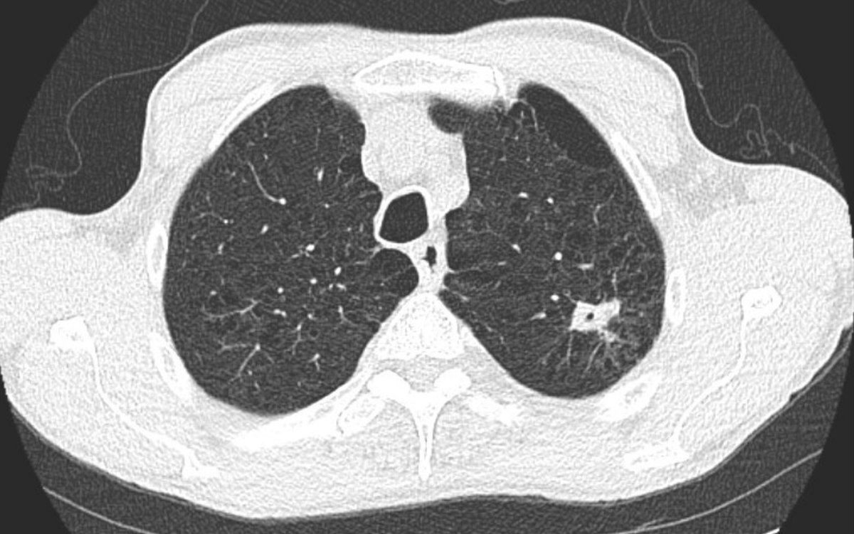 GS_Bronch tweet media