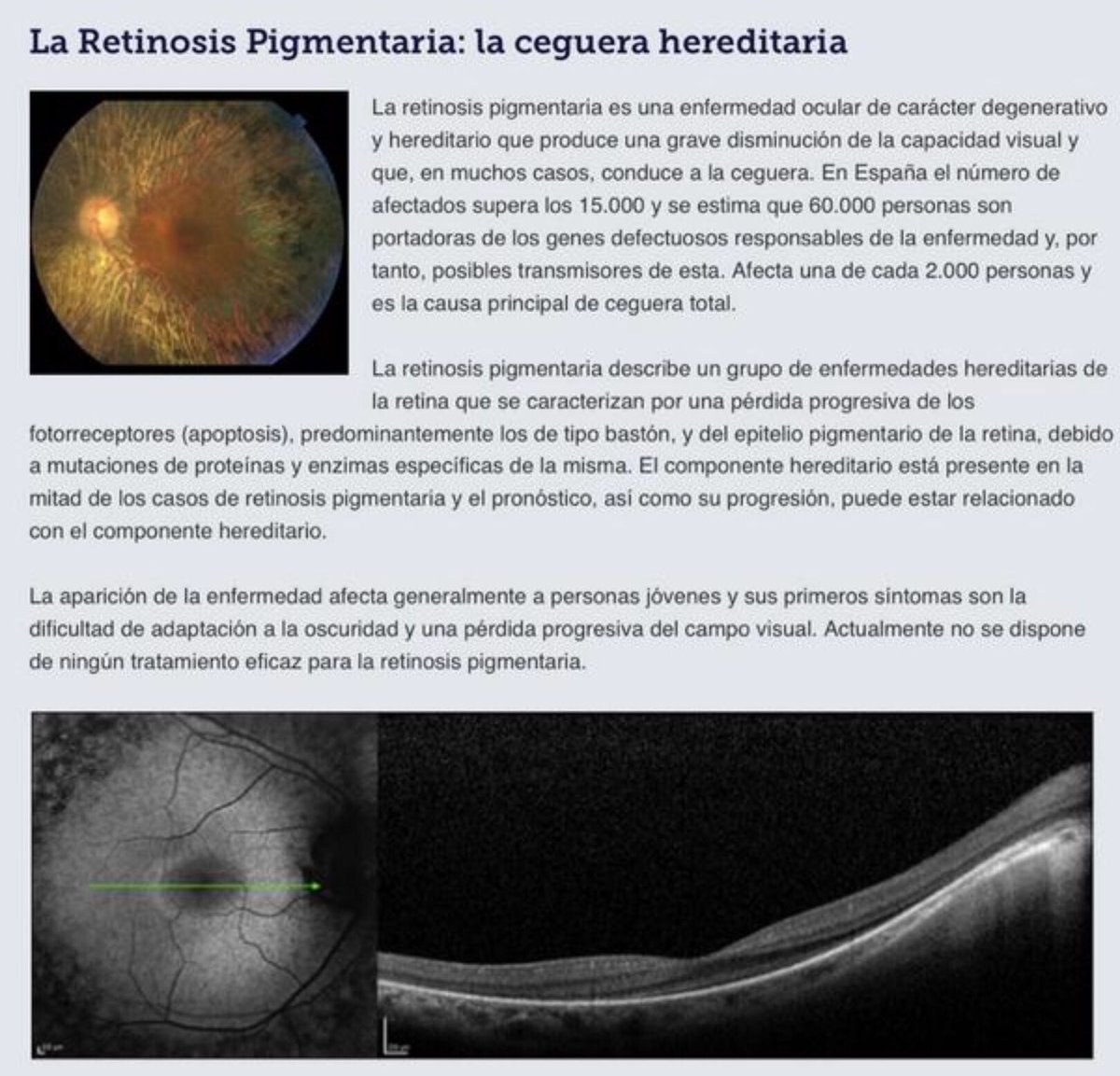 El último domingo de septiembre se celebra el Día Mundial de la #RetinosisPigmentaria.
Es Día Mundial de la Retina 2025 
Colaboramos en la campaña #LucesQueInspiran #DíaDeLaRetina
Esta tarde-noche, edificios emblemáticos de toda España se iluminarán de azul y verde 💙💚, como