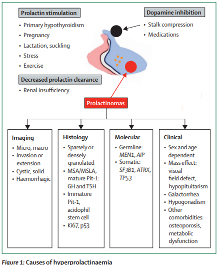 TheLancetEndo's tweet image. Sporadic #prolactinomas are the most common functioning #pituitary #adenomas, with a female predominance during reproductive years. In men, these adenomas are usually larger and more aggressive thelancet.com/journals/landi… 
#hyperprolactinaemia