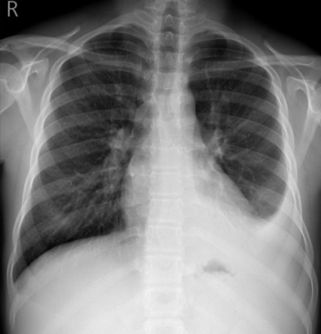 A 20yo male came to the ER with fever, chills and shortness of breath. A chest X-ray was done. 🚑

What is the name of the sign you see? 
What does it classically indicate?