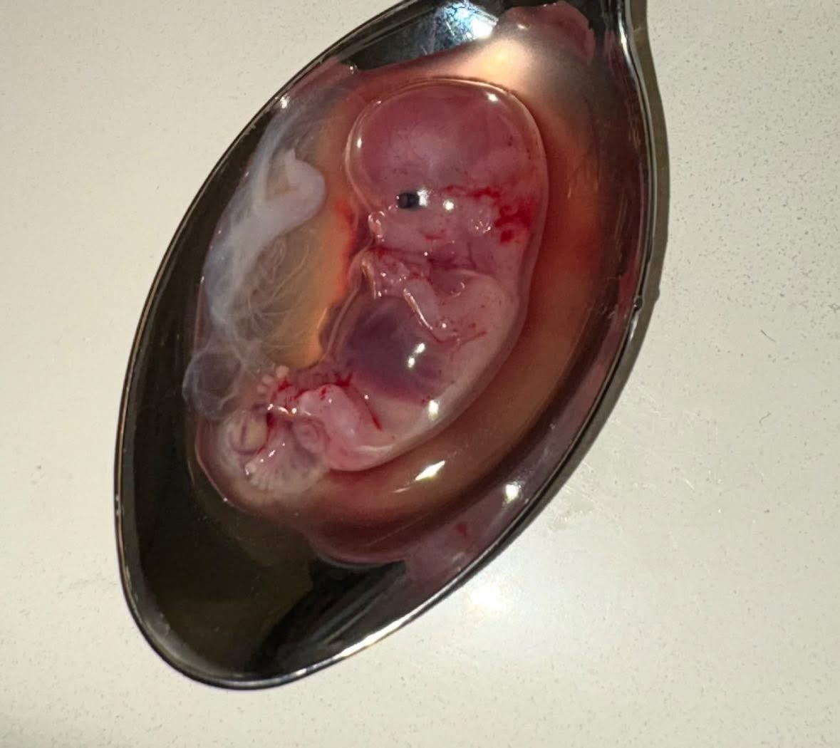 _LauraKlassen's tweet image. Baby aborted at ten weeks. #abortionpill #abortion