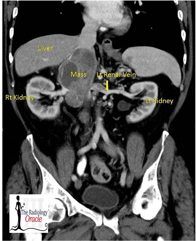 TheRadOracle's tweet photo. A 73-year-old man was sent for evaluation of chronic diffuse abdominal pain accompanied by anorexia and weight loss. 

Ans in 🧵

#foamrad #radres https://t.co/kNR768y0YW